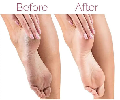 Rechargeable Flawless Electric Foot Callus and dead body Remover - Chic Flicks Store